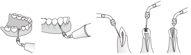 Сфера применения наконечника для скалера